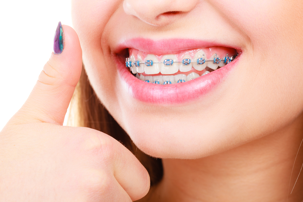 dental braces